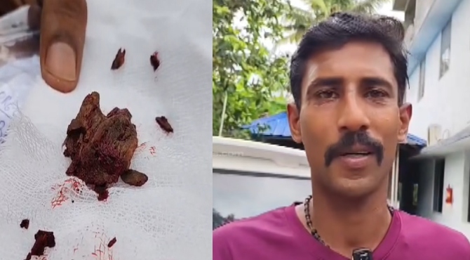 തിരുവനന്തപുരം മെഡിക്കൽ കോളജിൽ വീണ്ടും ചികിത്സാ പിഴവ്; രോഗിയുടെ കാലിൽ നിന്ന് 2 മാസത്തിന് ശേഷം മരക്കഷണം പുറത്തെടുത്തു