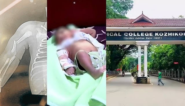 പ്രസവത്തിനിടെ നവജാത ശിശുവിന്റെ കൈ പൊട്ടി; കോഴിക്കോട് മെഡിക്കൽ കോളജിനെതിരെ ചികിത്സാ പിഴവ് ആരോപണം